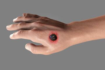 Cutaneous anthrax, the most common form of anthrax