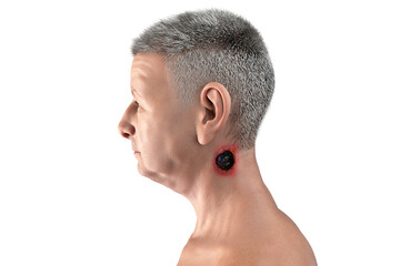 Obraz premium Cutaneous anthrax, the most common form of anthrax