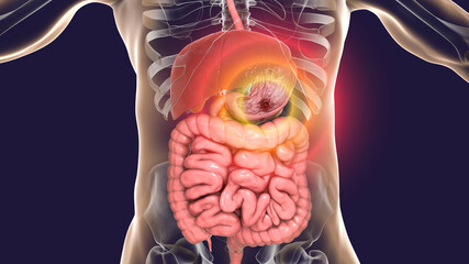 Peptic ulcer, stomach ulcer