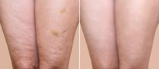 Thighs of a woman with cellulite and bruises before and after medical treatment - obrazy, fototapety, plakaty
