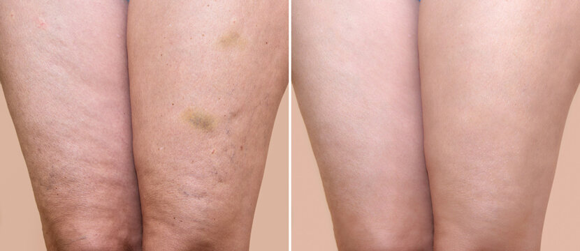 Cellulite thighs before and after on sale