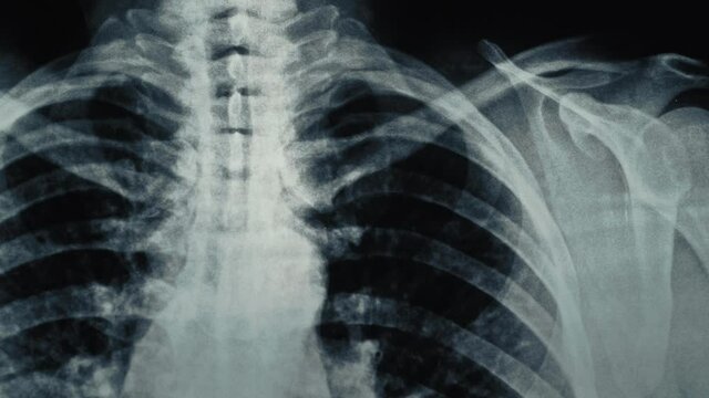 Radiological chest x-ray film, panoramic shot. Asthma, COVID-19, coronavirus or pneumonia diagnostic concept.