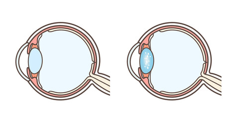 白内障の説明の図解