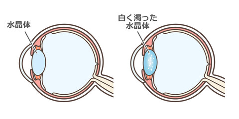 白内障の説明の図解