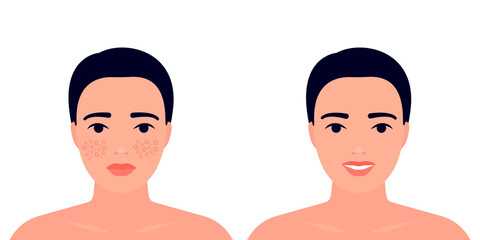 Woman before and after acne on skin face treatment. Inflamation skin, spot and pimple. Dermatology, cosmetology problem. Skin care, higiene, clean. Vector illustration