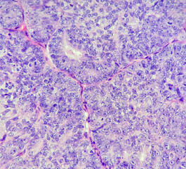 Naklejka premium Photo of endometrial adenocarcinoma, showing endometrioid subtype, magnification 400x, photo under microscope
