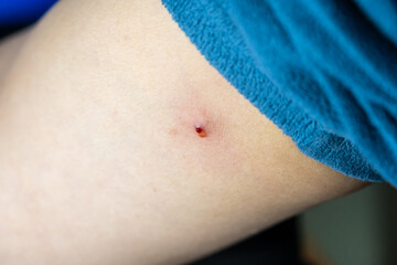 An arm with a drop of blood after squeezing a pimple