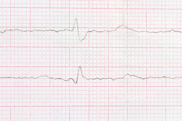 Macro or close-up ECG cardiogram of a patient with left bundle branch block. Diagnosis and treatment of heart disease