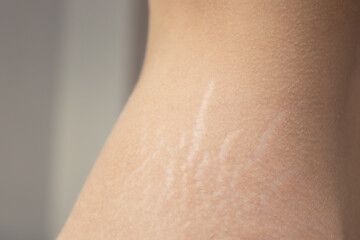 Visible stretch marks on Woman hips