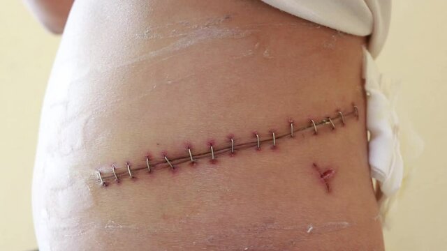 Surgical Incision In The Abdomen Using Staples, Traces Of Kidney Surgery, Drainage In The Wound