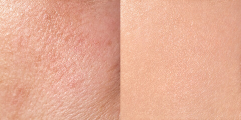Fototapeta premium Skin care procedure