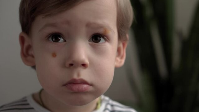 close up sad minor preschool boy kid with iodine-smeared acne on face looks at camera and talking. portrait of child with treated warts or molluscs near eyes. medicine and health, pediatrics concept