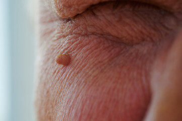 Fototapeta premium Neoplasm - human papillomavirus on the face of an elderly man, small selective depth of field, defocus, close-up of skin and pores on the surface in the upper part of the cheek