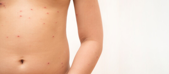 Close-up of naked body Chickenpox disease, Little girl ill with chickenpox on white background. Chickenpox virus, chickenpox outbreak in children. Concept of contagion.