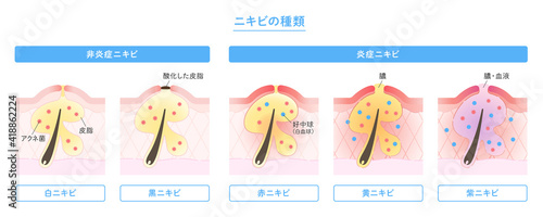 肌断面図で見せるニキビの種類のイラスト Wall Mural Ayano