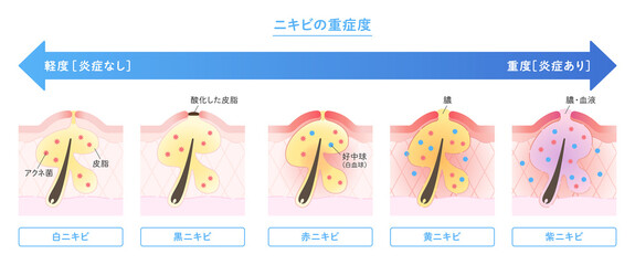 肌断面図で見せるニキビの種類と重症度のイラスト