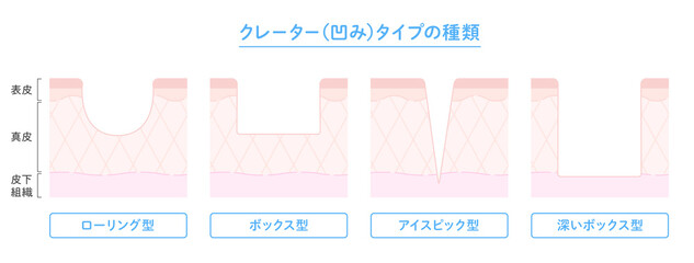 クレータータイプのニキビ跡の種類と肌断面図のイラスト
