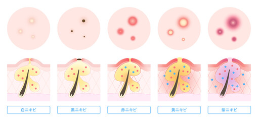 ニキビの種類と肌断面図のイラスト