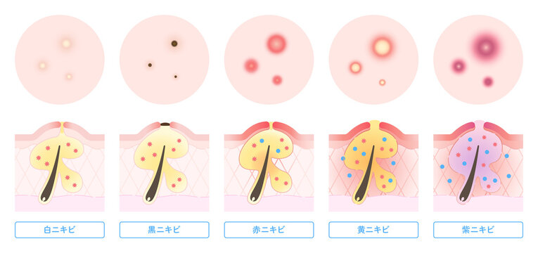 ニキビの種類と肌断面図のイラスト