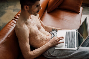 Man with scars at the skin after burn sitting at the sofa with laptop computer