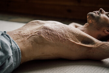 Naked man with scars at the skin after burn laying at the floor after exercises