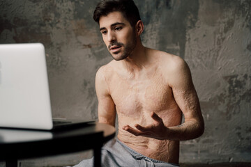 Boy with scars at the skin after burn sitting at home and talking with friend or family