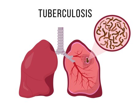 Human lungs infected Mycobacterium tuberculosis.