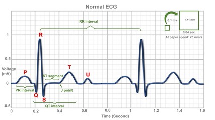 normal electrocardiogram explaining waves and intervals