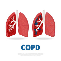 Vector Illustration of Chronic obstructive pulmonary disease.
