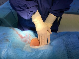 Scrub nurse press on patient’s groin for stop bleed at puncture site during cardiac...