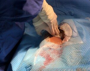 Scrub nurse press on patient’s groin for stop bleed at puncture site during cardiac...