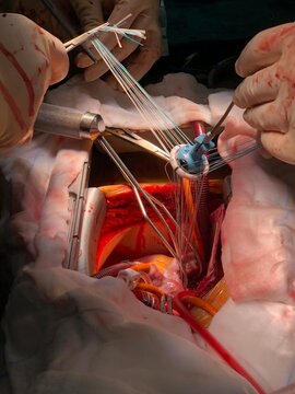Implantation of prosthetic heart valve (mechanical valve) in operating room during open heart surgery.