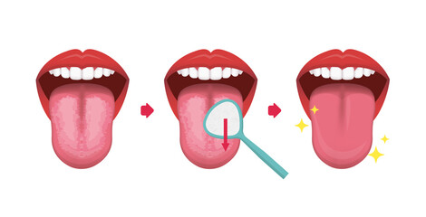 How to clean your tongue vector illustration (Halitosis prevention)