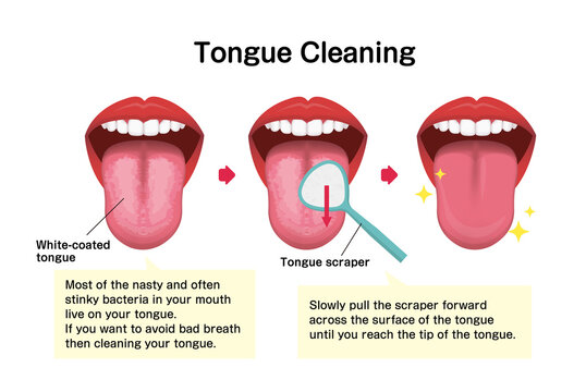 How to clean your tongue vector illustration (Halitosis prevention)