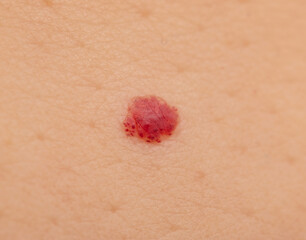 burst capillary on the skin in the form of a spot