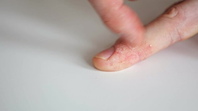 The man scratches fingers with psoriasis close-up.