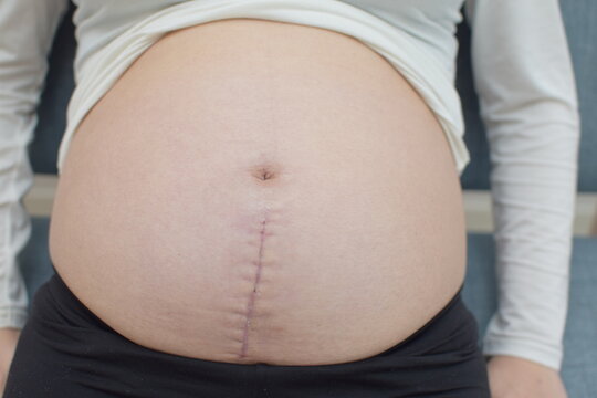 It is a trace of laparotomy on the abdomen of a young pregnant woman.
