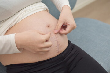 A young pregnant woman is caring for a scar that has undergone laparotomy with tape.