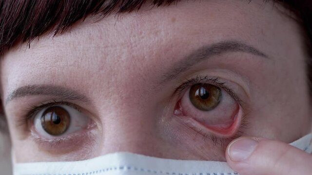 Young Girl in Mask Rotates Red, Bloodshot Eyes. Viral Conjunctivitis. Zoom