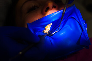 Close-up of the patient's mouth after filling the teeth with white composite resin on the insulation of a rubber dam, rubber dam and dental mirror.