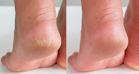 Image before and after treatment of dry heels cracks skin dehydrated skin on heels of female feet.