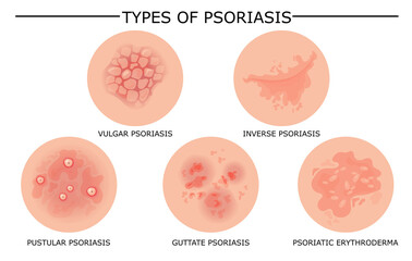 Different types of psoriasis vector set. Part of patients skin with dermatitis, inflammation, red rash and other skin problems. Cartoon illustration for disease concept - obrazy, fototapety, plakaty