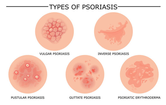 Different types of psoriasis vector set. Part of patients skin with dermatitis, inflammation, red rash and other skin problems. Cartoon illustration for disease concept