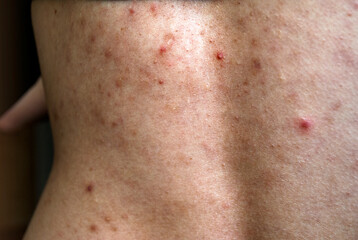A young girl with acne, with red spots and black dots on her back.Problem skin.