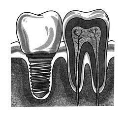 Hand drawing, line art, engraving, ink Dental Illustration. Vintage Tooth structure. Dental prosthetics. Dental nerves. Isolated in white background. For medical poster and brochure.