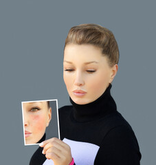 Post-Acne Marks /Treating Acne Scars.Acne Scar Removal.