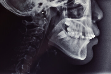 x-ray image of a human skull