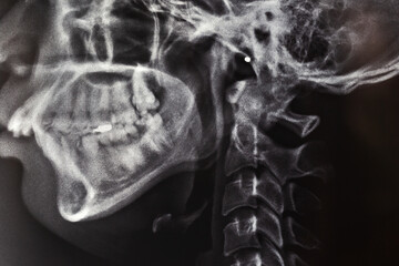 x ray image of human skull