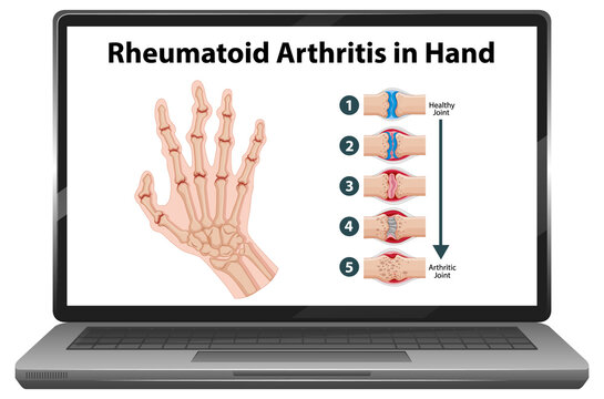 Rheumatoid arthritis symptoms on hand on laptop screen
