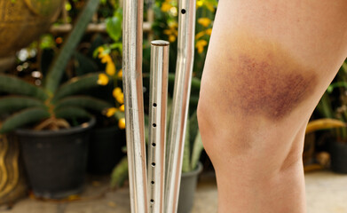 Hematoma and Large Bruise, blood under skin Congestion